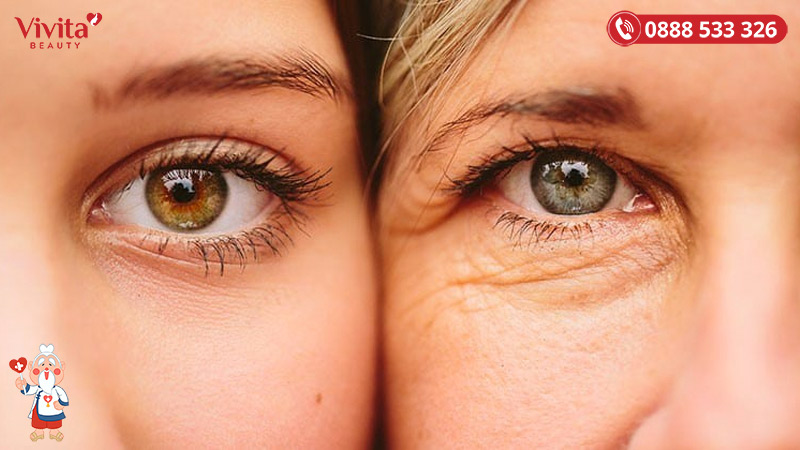 Càng có tuổi, vùng da quanh mắt càng có xu hướng mỏng đi, tăng thêm nếp nhăn và bị sẫm màu